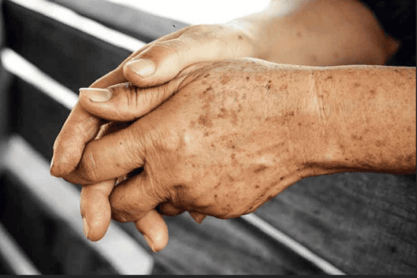 age spot removal