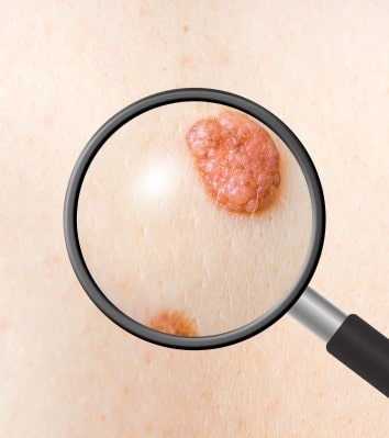 benign mole removal