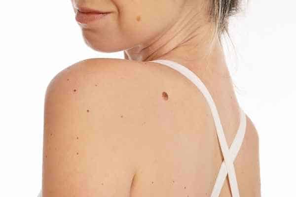 Dermatofibroma