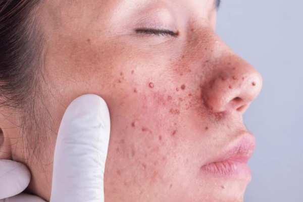 Angiofibroma Treatment