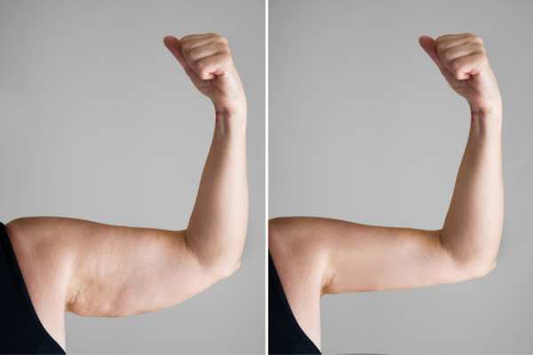 HIFU before and after