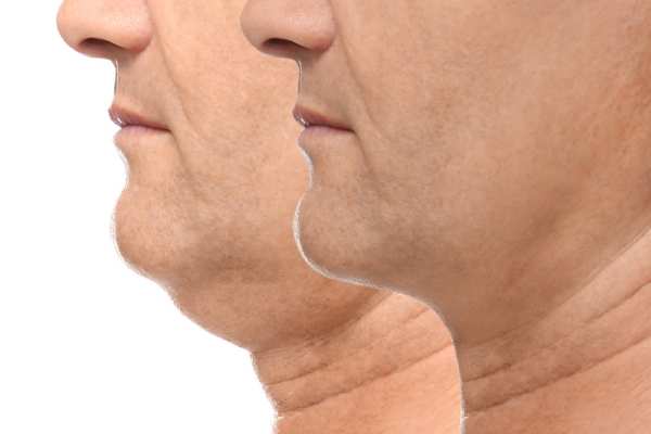 Book your Chin Reduction Treatment Port Glasgow today!