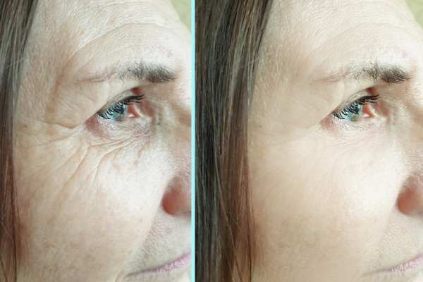hifu before and after 6