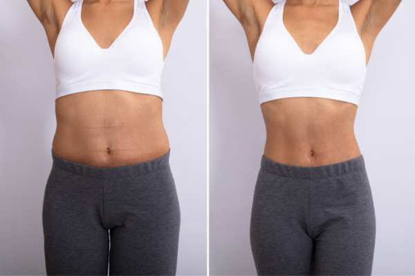 hifu before and after 8