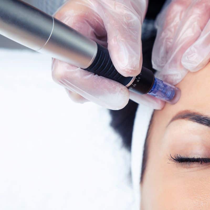 Morpheus8 treatment Port Glasgow from Lipo Sculpt - Book in today!