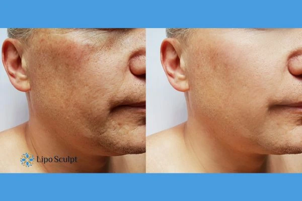 Get your Morpheus8 treatment Port Glasgow booked in today!